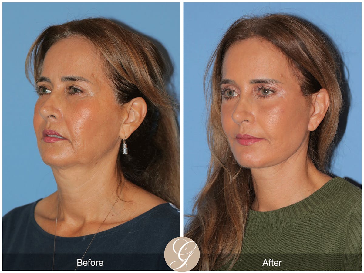 Preservation Facelift Before & After Gallery - Patient 167839 - Image 8