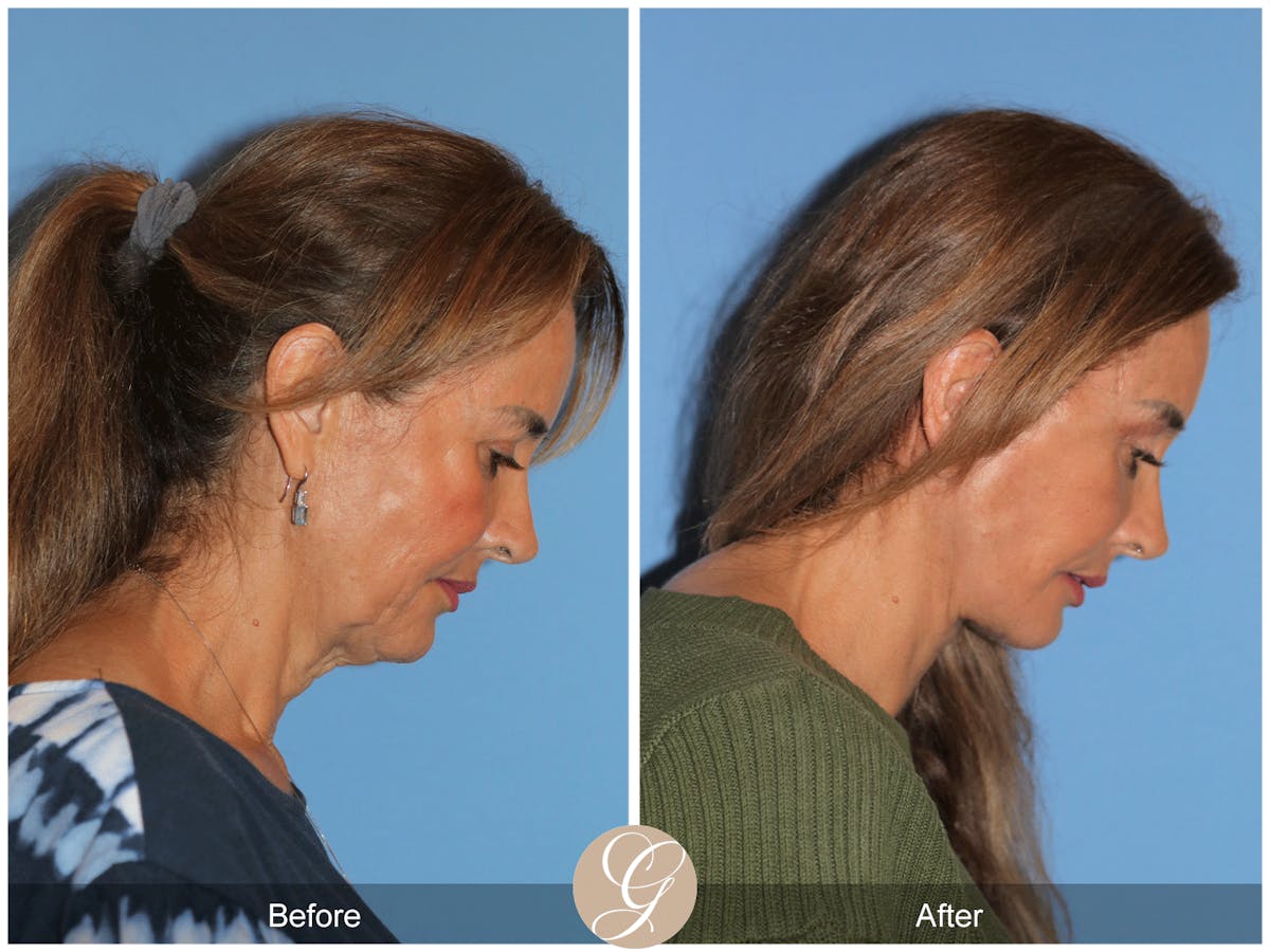 Preservation Facelift Before & After Gallery - Patient 167839 - Image 4