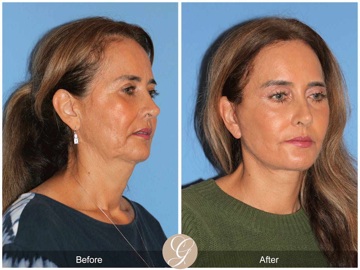 Preservation Facelift Before & After Gallery - Patient 167839 - Image 3