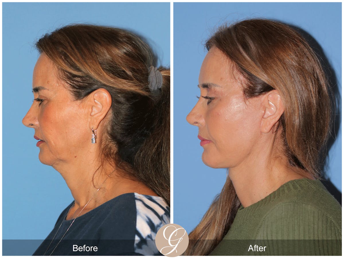 Preservation Facelift Before & After Gallery - Patient 167839 - Image 7