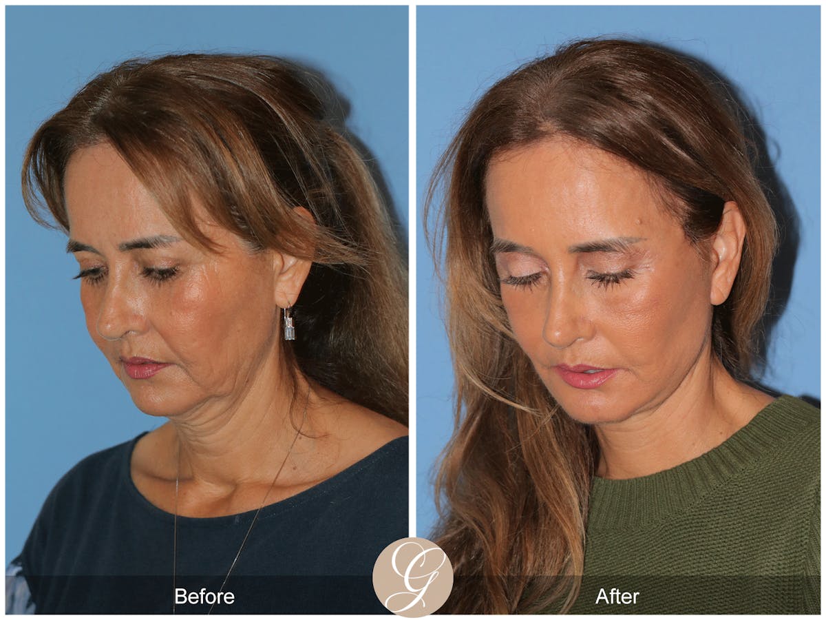 Preservation Facelift Before & After Gallery - Patient 167839 - Image 9
