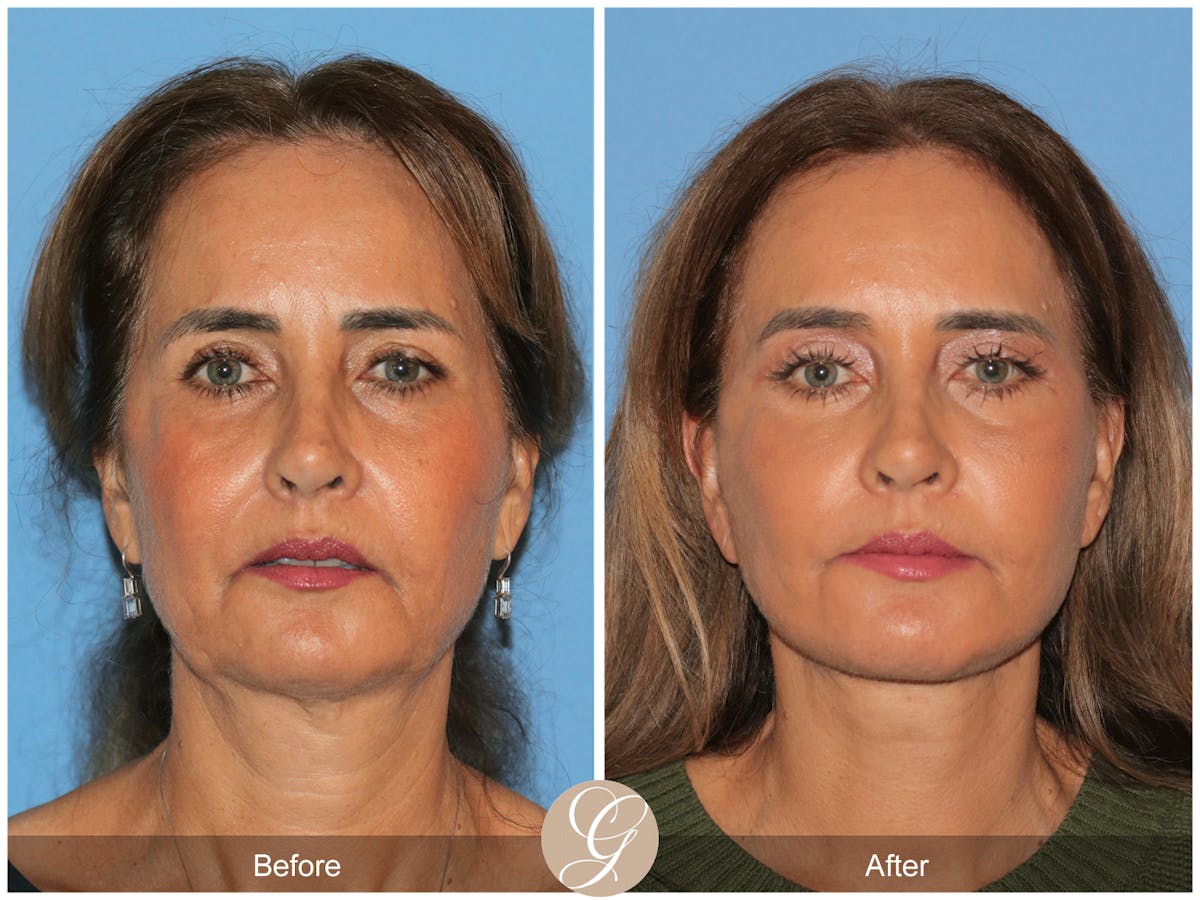 Preservation Facelift Before & After Gallery - Patient 167839 - Image 6