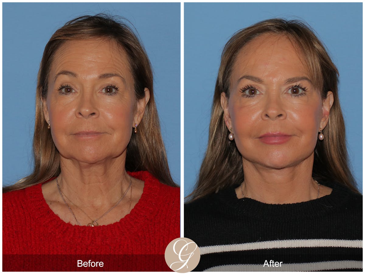 Deep Plane Facelift Before & After Gallery - Patient 357577 - Image 5