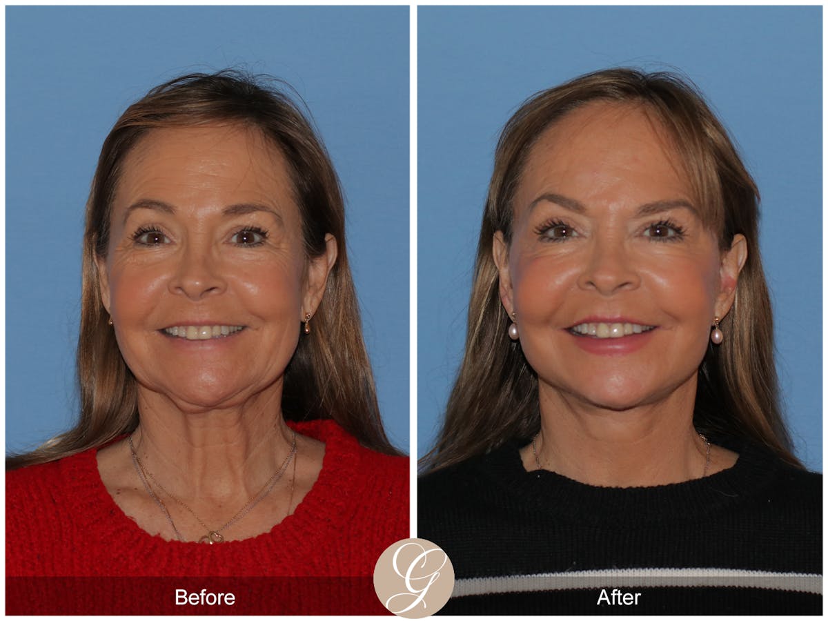 Deep Plane Facelift Before & After Gallery - Patient 357577 - Image 1