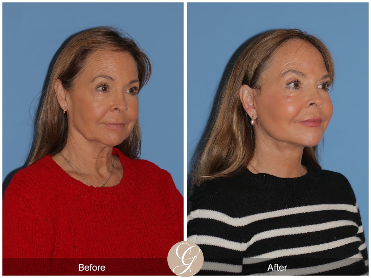 Deep Plane Facelift Before & After Gallery - Patient 357577 - Image 2