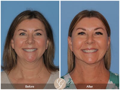 Deep Plane Facelift Before & After Gallery - Patient 143999 - Image 1