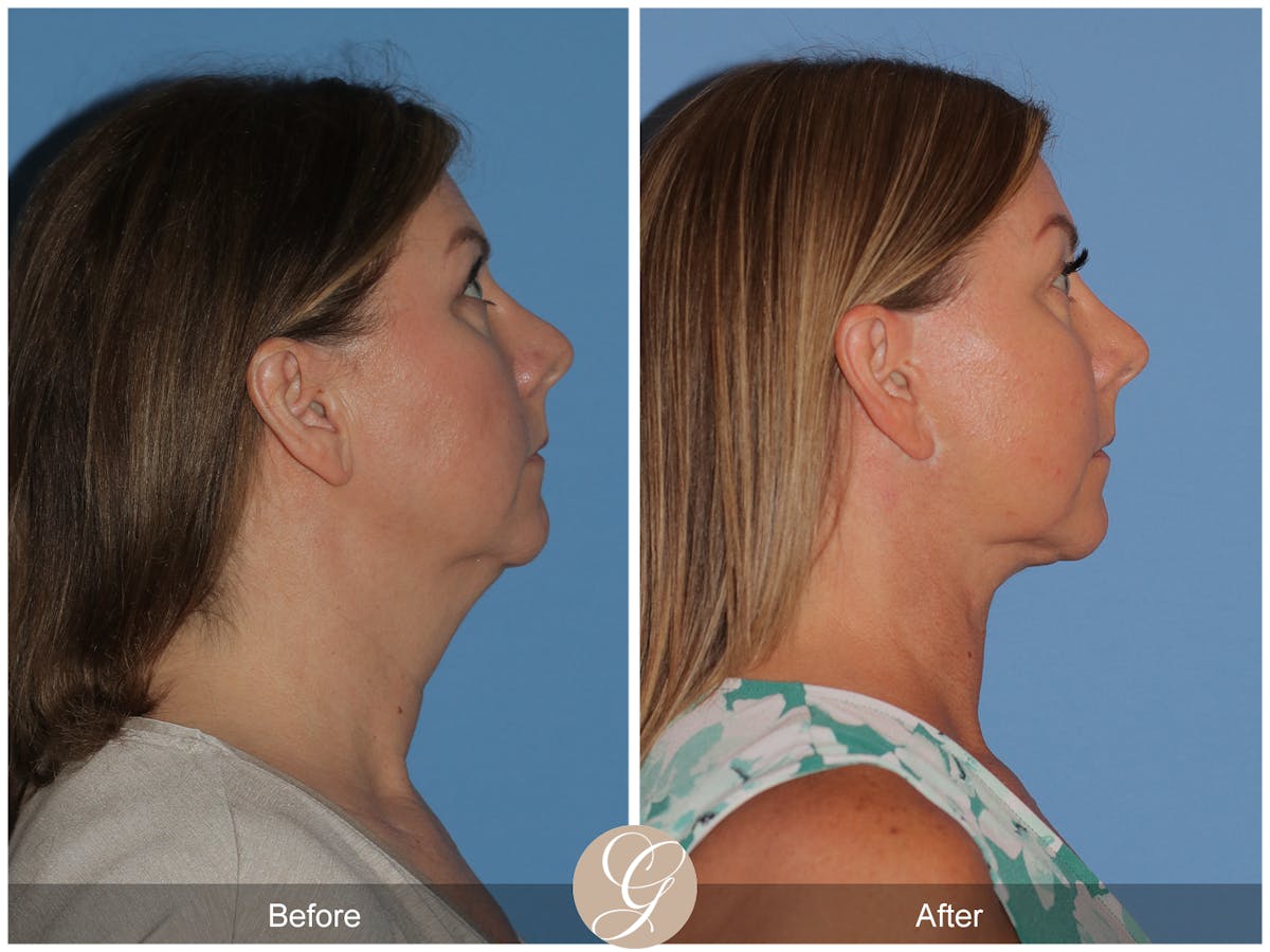 Deep Plane Facelift Before & After Gallery - Patient 143999 - Image 3