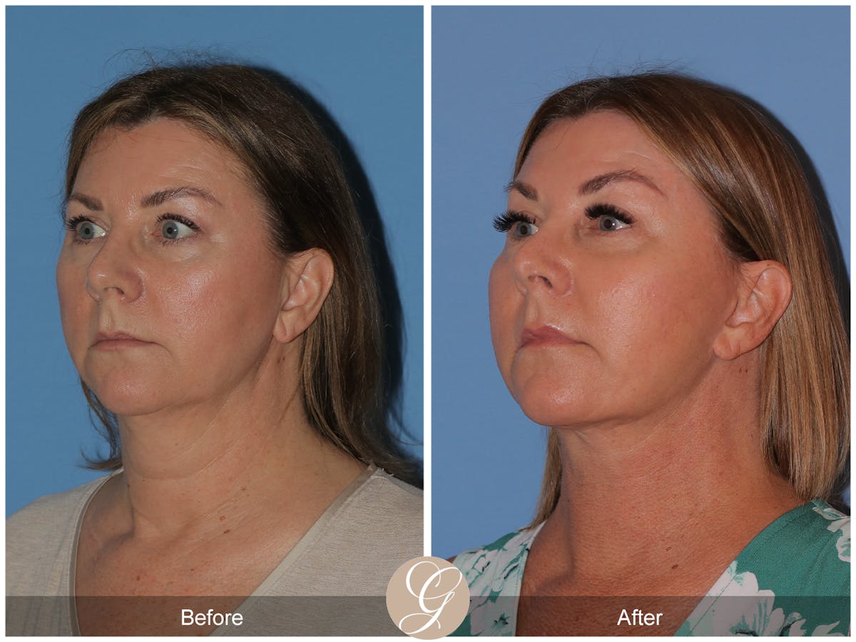 Deep Plane Facelift Before & After Gallery - Patient 143999 - Image 2