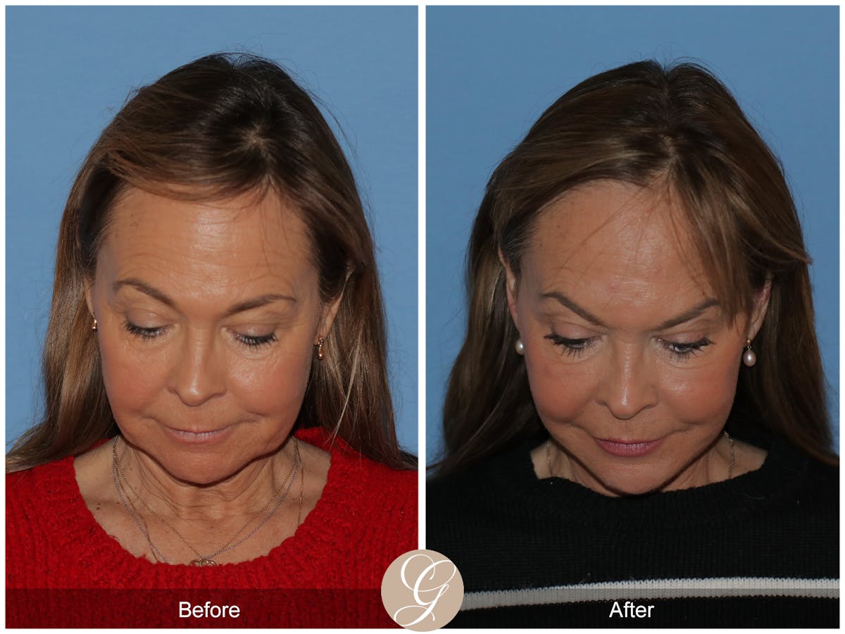 Deep Plane Facelift Before & After Gallery - Patient 357577 - Image 3