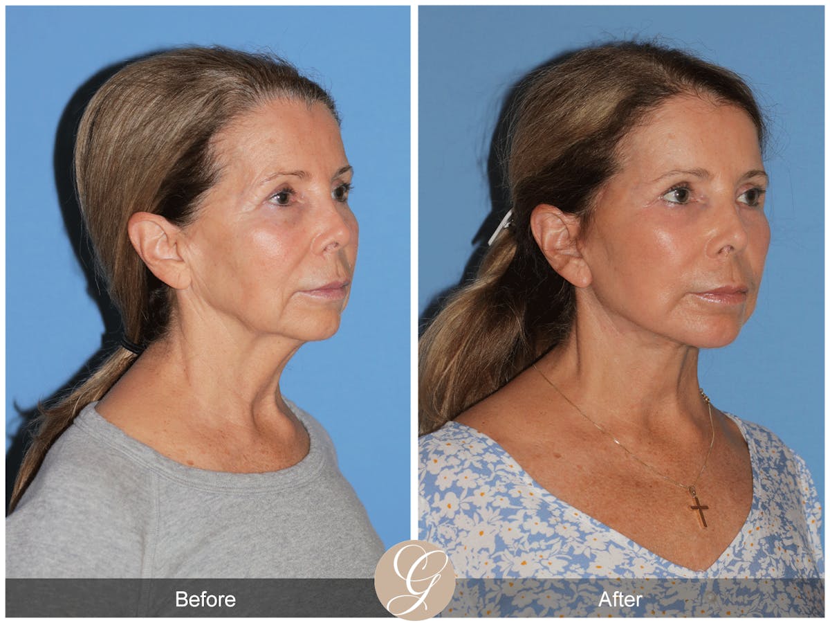 Preservation Facelift Before & After Gallery - Patient 101043 - Image 4