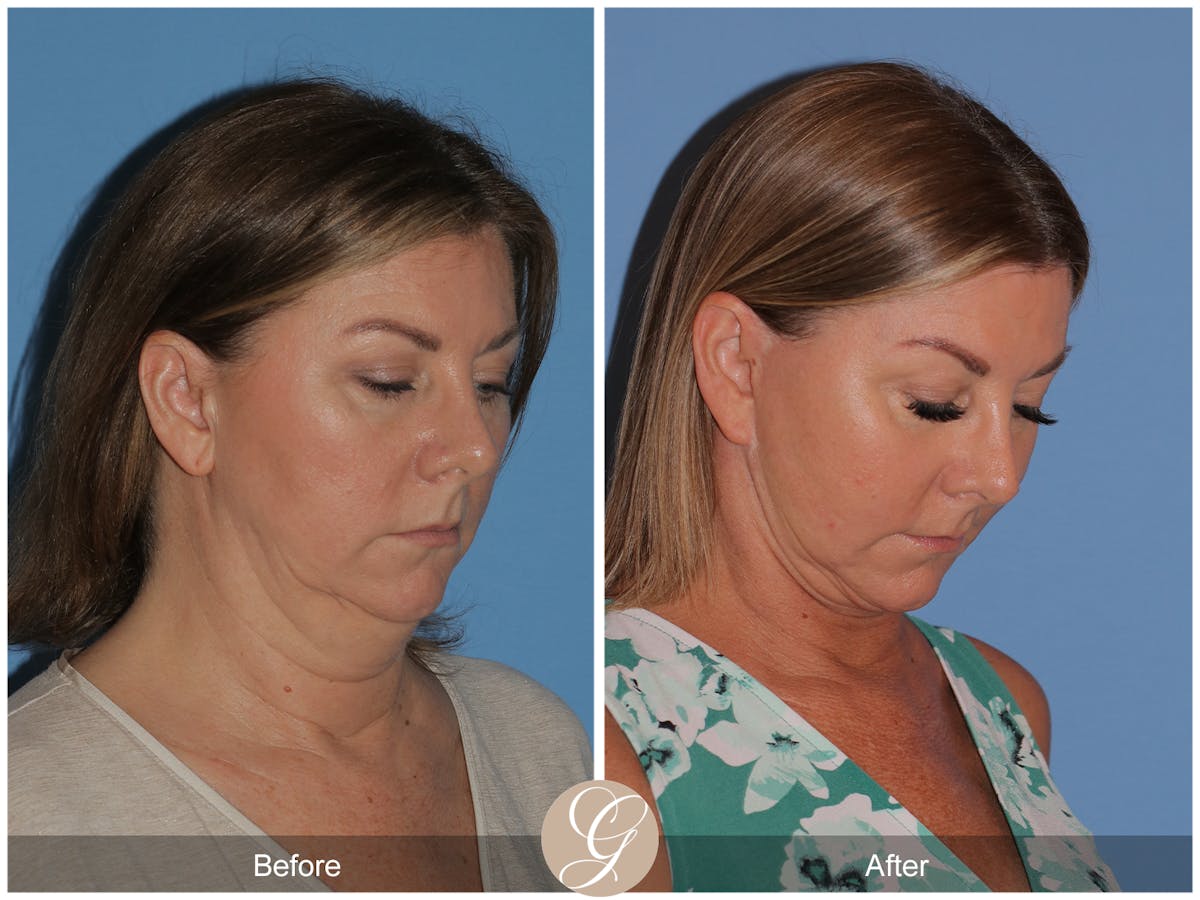 Deep Plane Facelift Before & After Gallery - Patient 143999 - Image 4