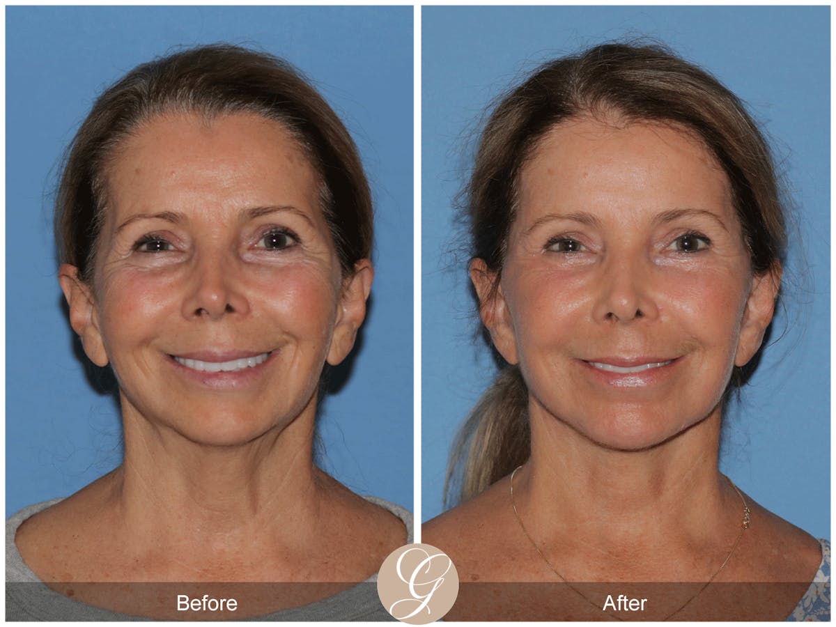 Preservation Facelift Before & After Gallery - Patient 101043 - Image 10