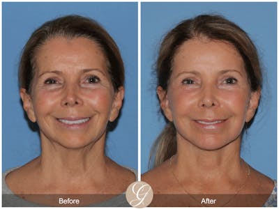 Deep Plane Facelift Before & After Gallery - Patient 261787 - Image 1