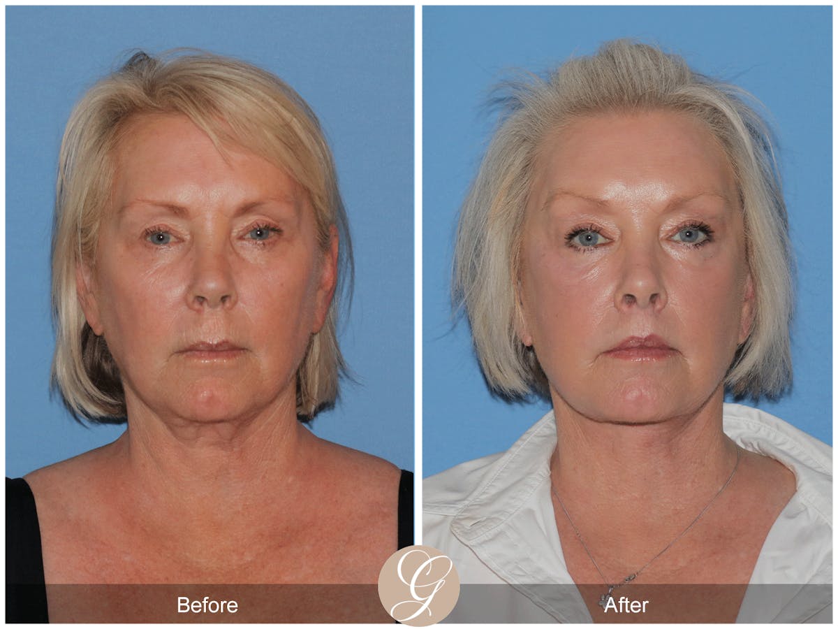Preservation Facelift Before & After Gallery - Patient 189291 - Image 1