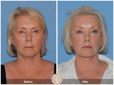 Deep Plane Facelift Before & After Gallery - Patient 243438 - Image 1