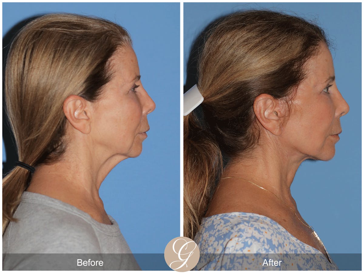 Preservation Facelift Before & After Gallery - Patient 101043 - Image 6