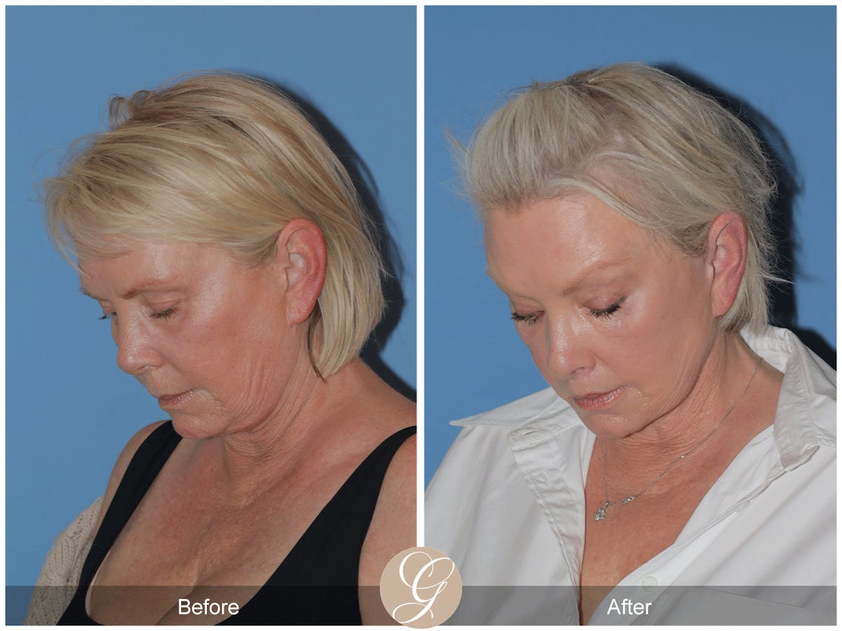Preservation Facelift Before & After Gallery - Patient 189291 - Image 3