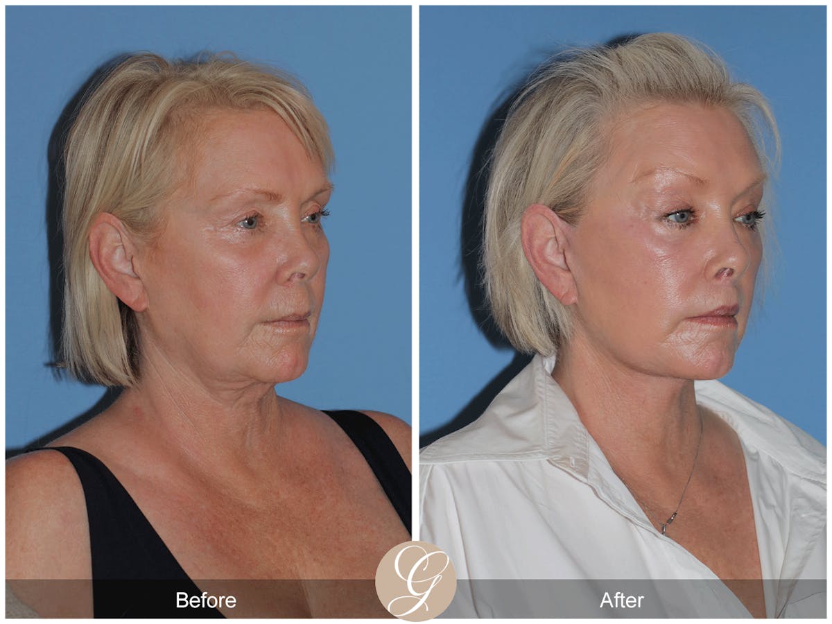 Preservation Facelift Before & After Gallery - Patient 189291 - Image 5