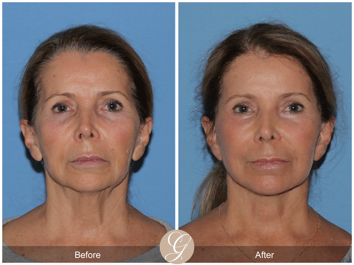 Preservation Facelift Before & After Gallery - Patient 101043 - Image 1