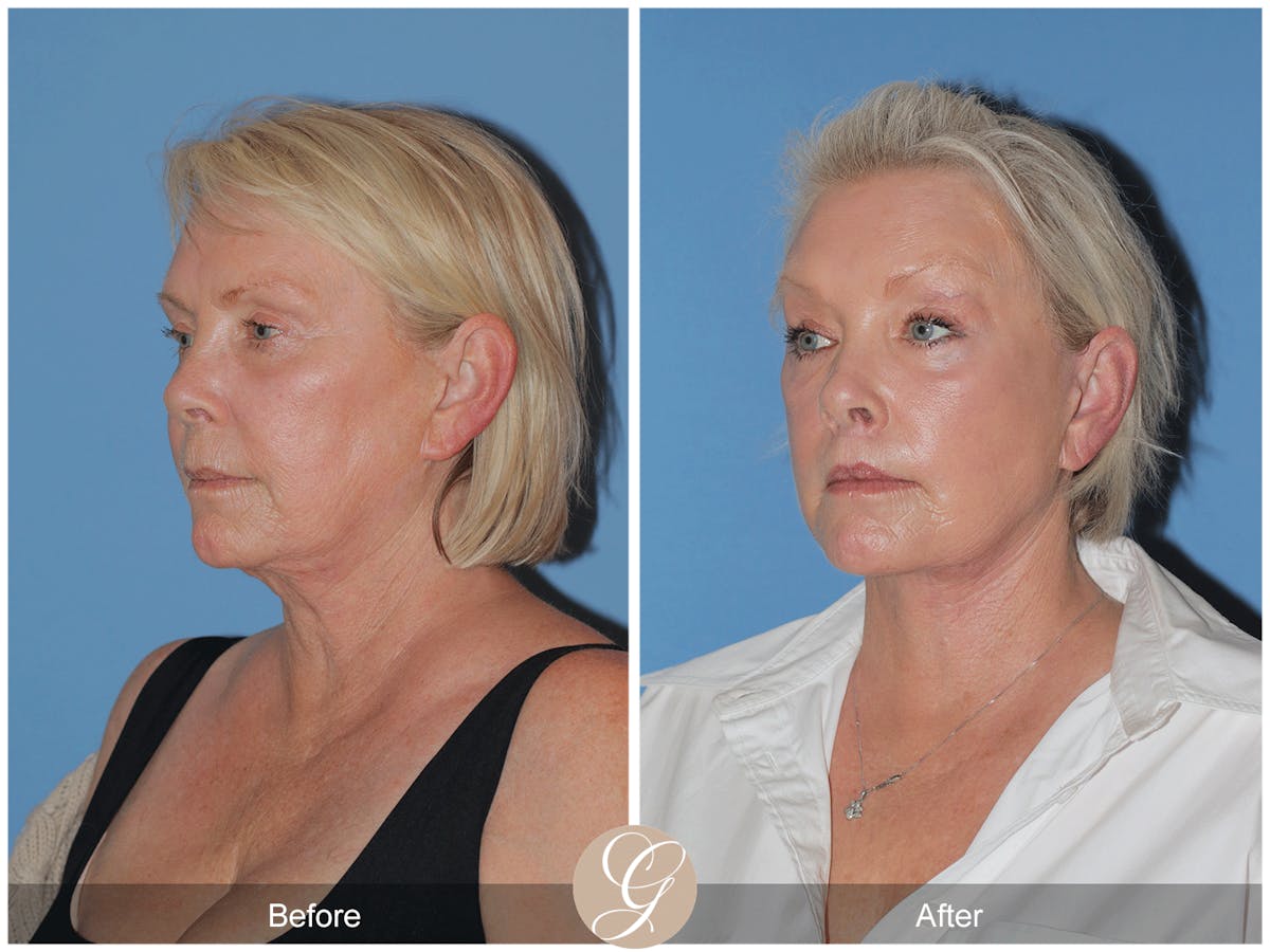 Preservation Facelift Before & After Gallery - Patient 189291 - Image 2