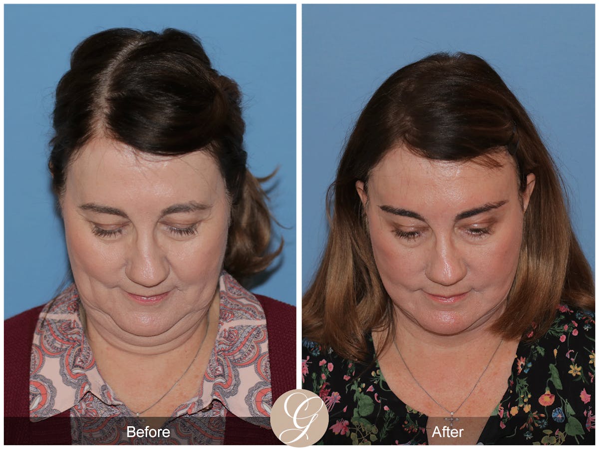 Preservation Facelift Before & After Gallery - Patient 134080 - Image 3
