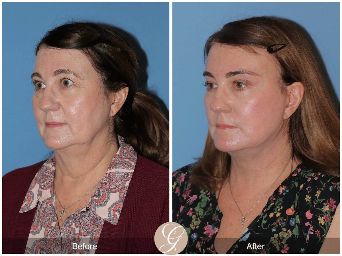 Preservation Facelift Before & After Gallery - Patient 134080 - Image 4