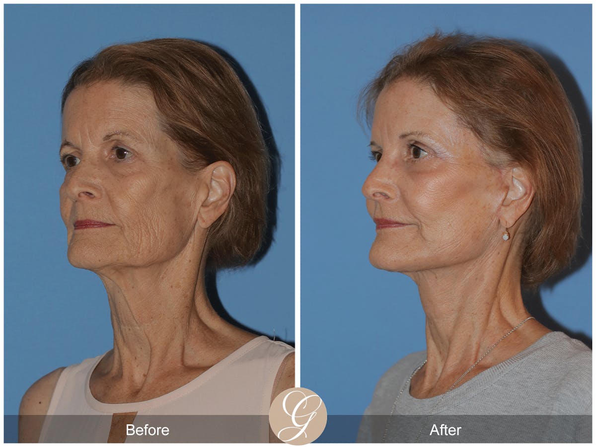Deep Plane Facelift Before & After Gallery - Patient 145205 - Image 2