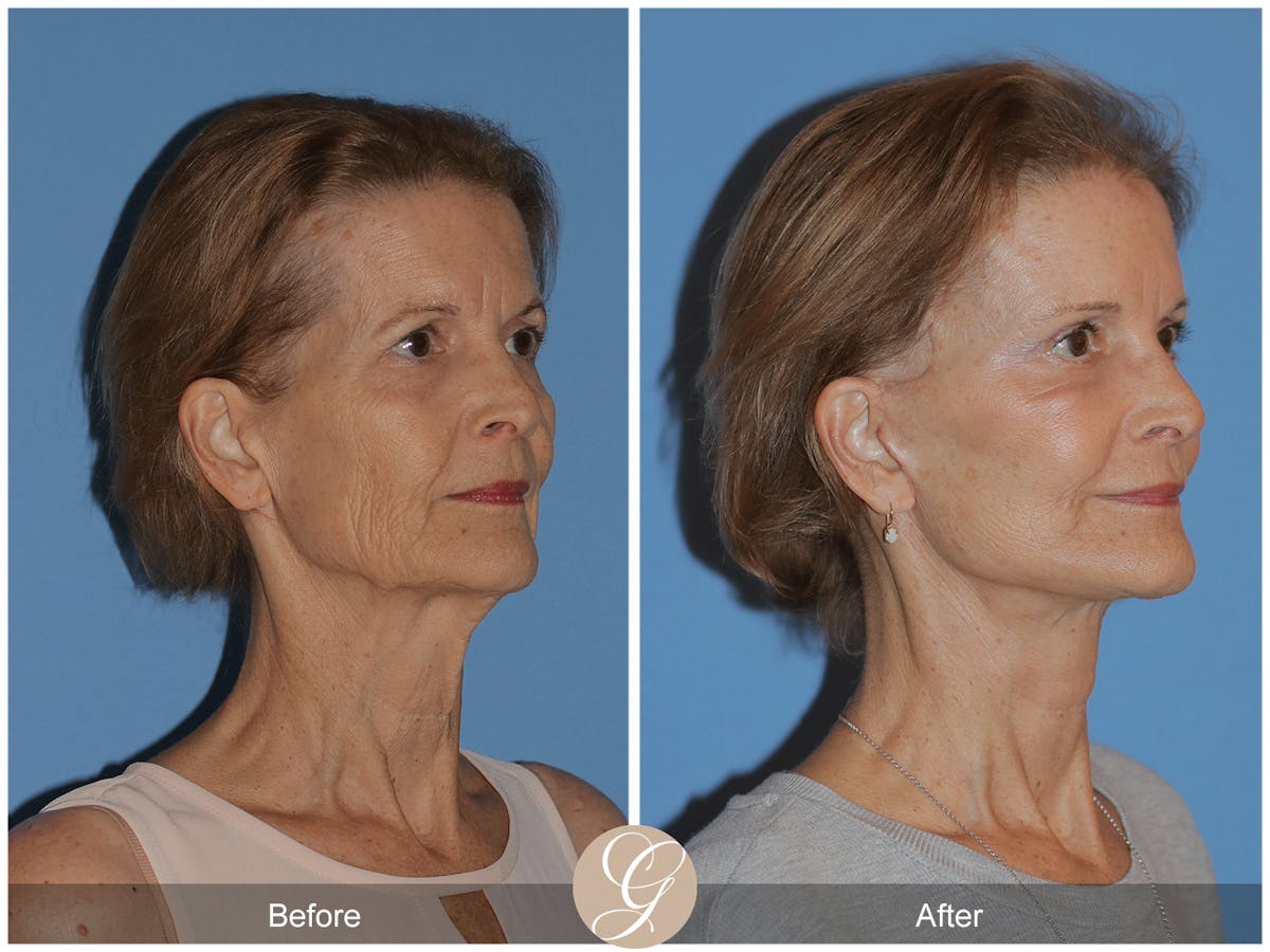 Deep Plane Facelift Before & After Gallery - Patient 145205 - Image 3