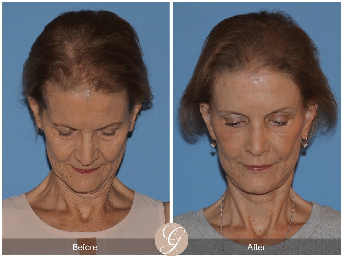 Deep Plane Facelift Before & After Gallery - Patient 145205 - Image 4