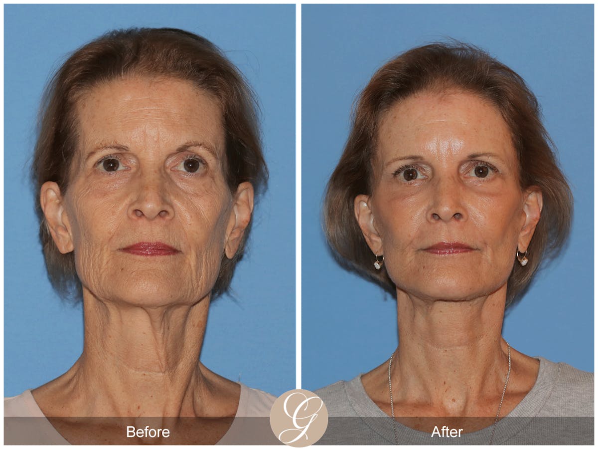 Deep Plane Facelift Before & After Gallery - Patient 145205 - Image 1