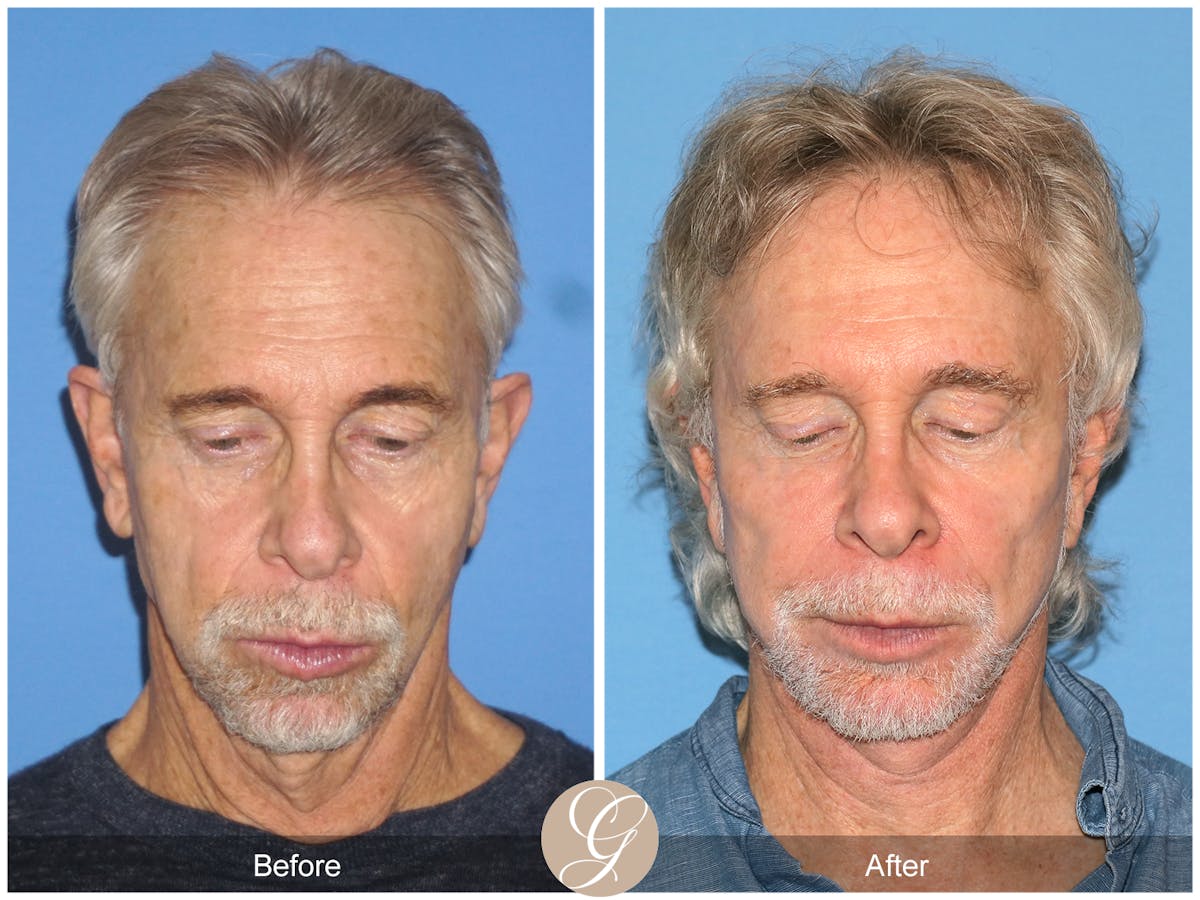 Preservation Facelift Before & After Gallery - Patient 353859 - Image 9