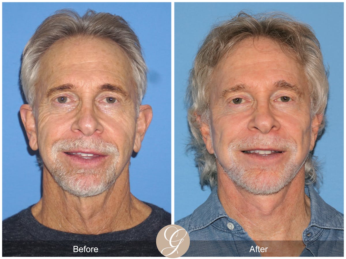 Preservation Facelift Before & After Gallery - Patient 353859 - Image 1