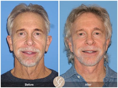 Deep Plane Facelift Before & After Gallery - Patient 196921 - Image 1