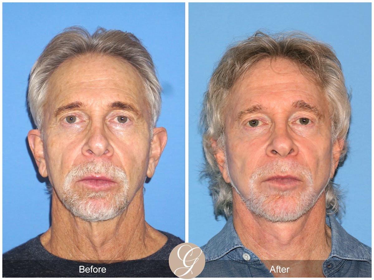 Preservation Facelift Before & After Gallery - Patient 353859 - Image 5
