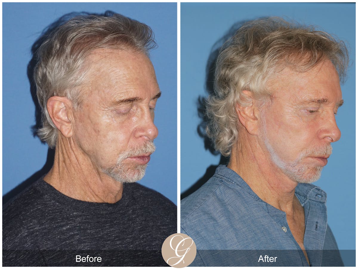 Preservation Facelift Before & After Gallery - Patient 353859 - Image 4