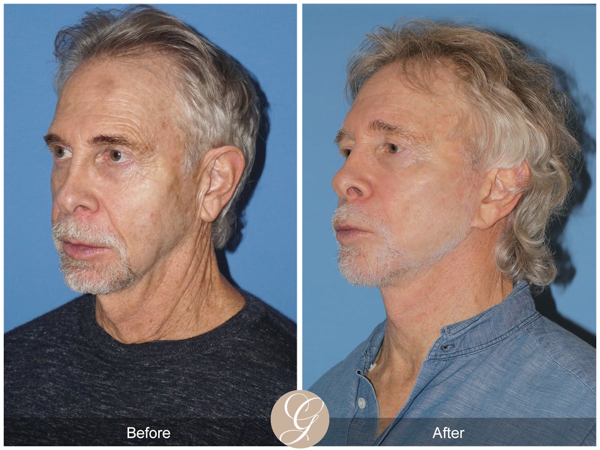Preservation Facelift Before & After Gallery - Patient 353859 - Image 7