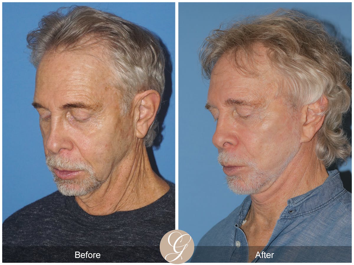 Preservation Facelift Before & After Gallery - Patient 353859 - Image 8