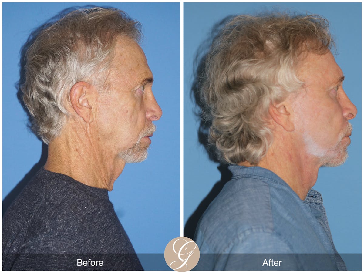 Preservation Facelift Before & After Gallery - Patient 353859 - Image 6