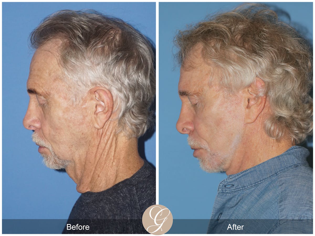 Preservation Facelift Before & After Gallery - Patient 353859 - Image 2