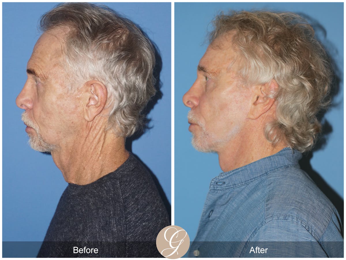 Preservation Facelift Before & After Gallery - Patient 353859 - Image 3