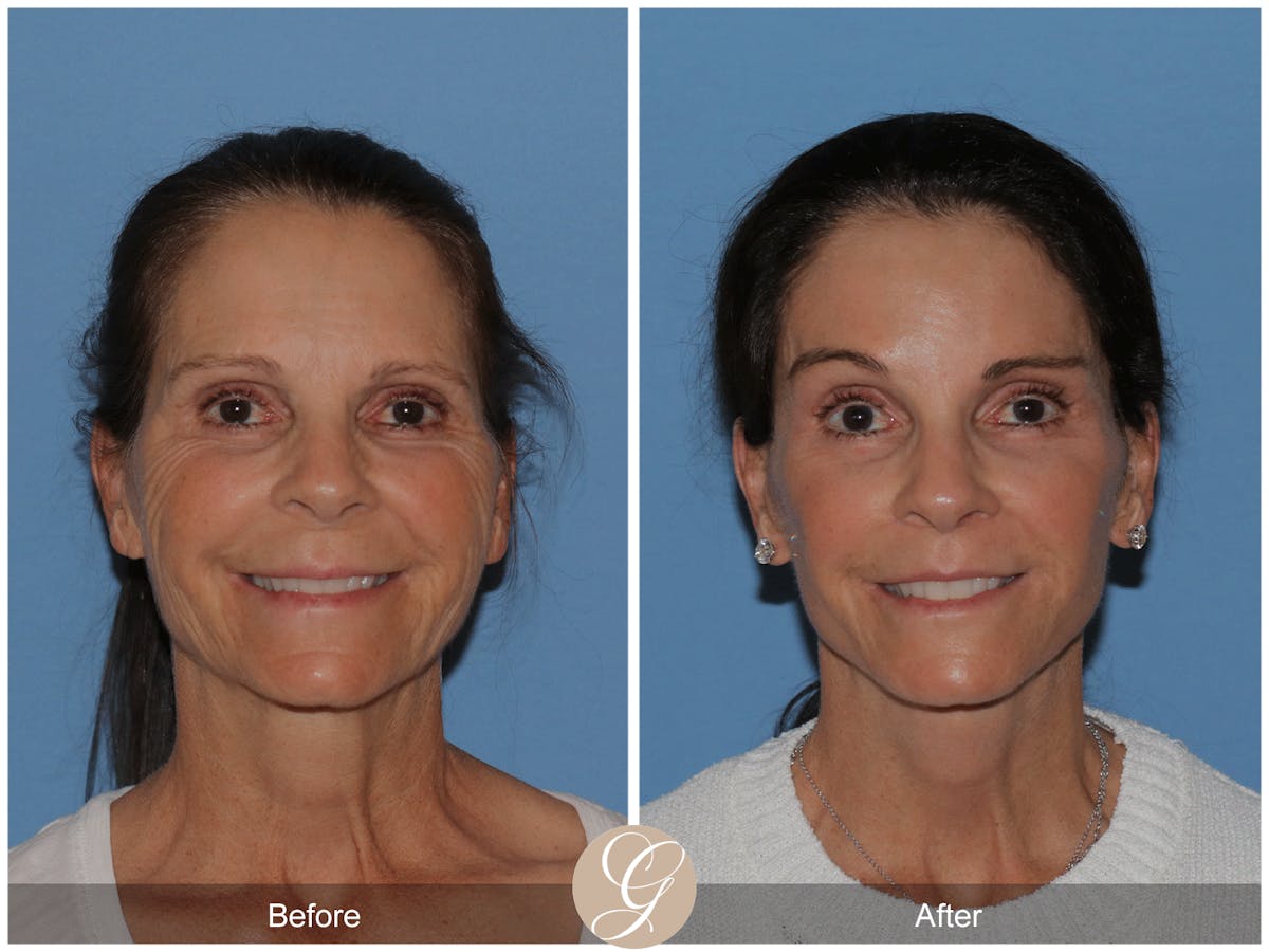 Preservation Facelift Before & After Gallery - Patient 421936 - Image 2