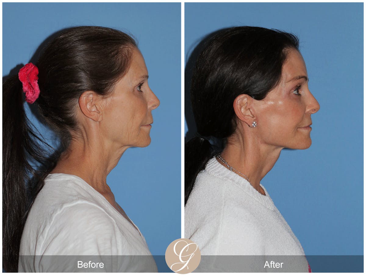 Preservation Facelift Before & After Gallery - Patient 421936 - Image 8