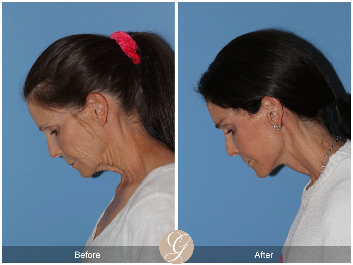 Preservation Facelift Before & After Gallery - Patient 421936 - Image 11