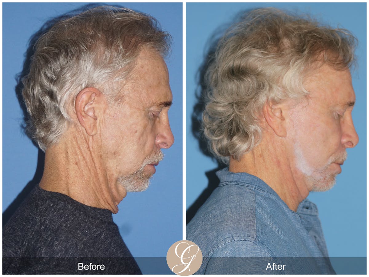Preservation Facelift Before & After Gallery - Patient 353859 - Image 11