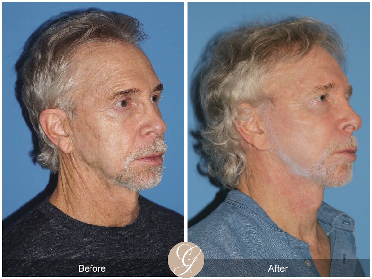 Preservation Facelift Before & After Gallery - Patient 353859 - Image 10