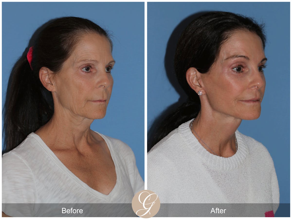Preservation Facelift Before & After Gallery - Patient 421936 - Image 6