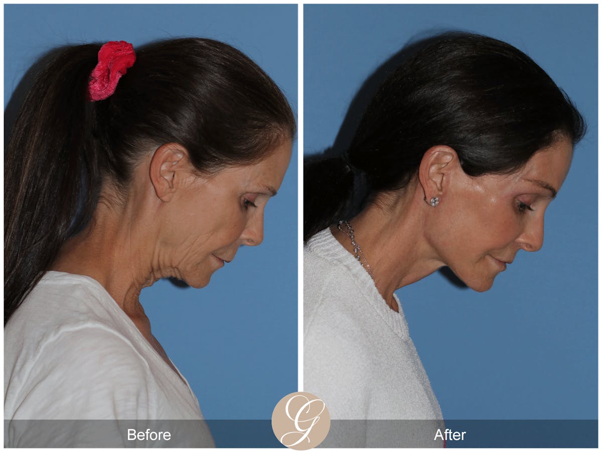 Preservation Facelift Before & After Gallery - Patient 421936 - Image 7