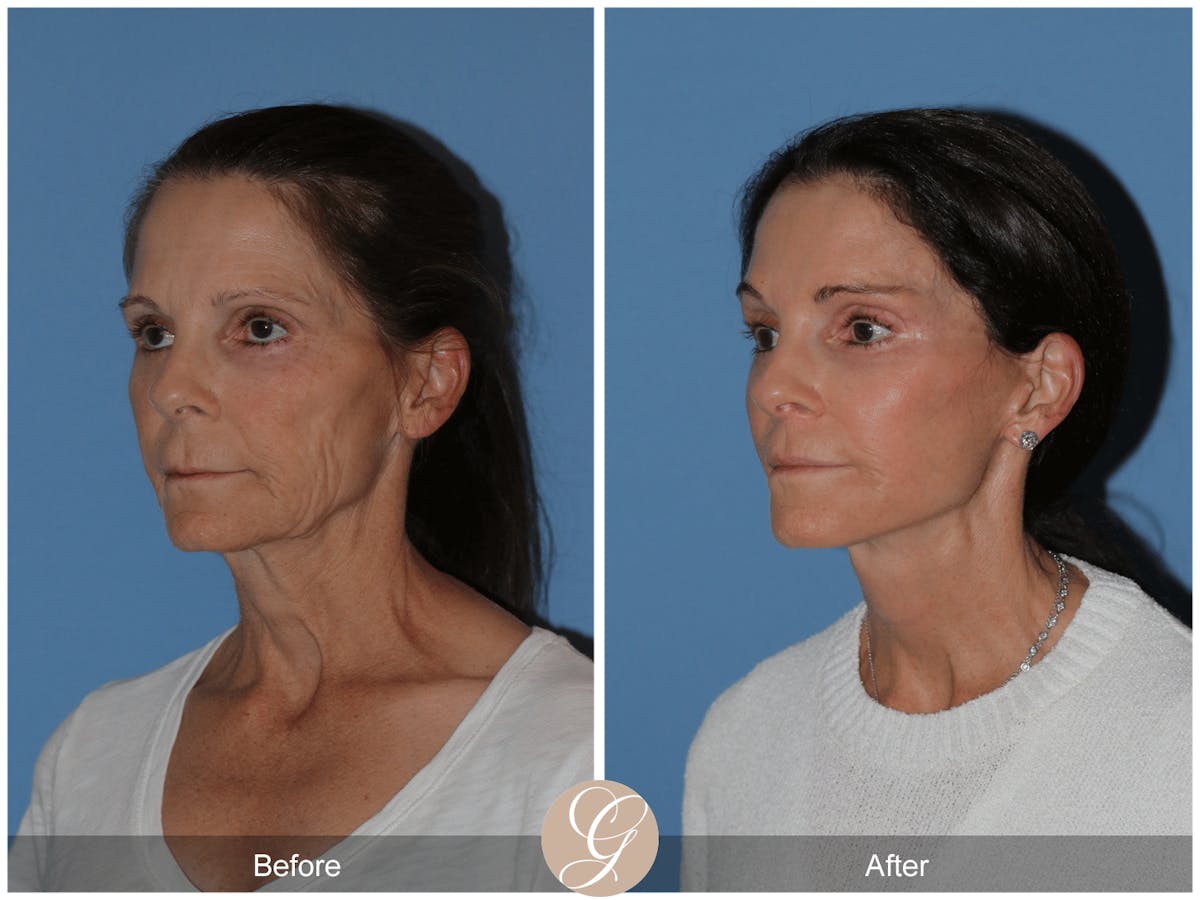 Preservation Facelift Before & After Gallery - Patient 421936 - Image 3