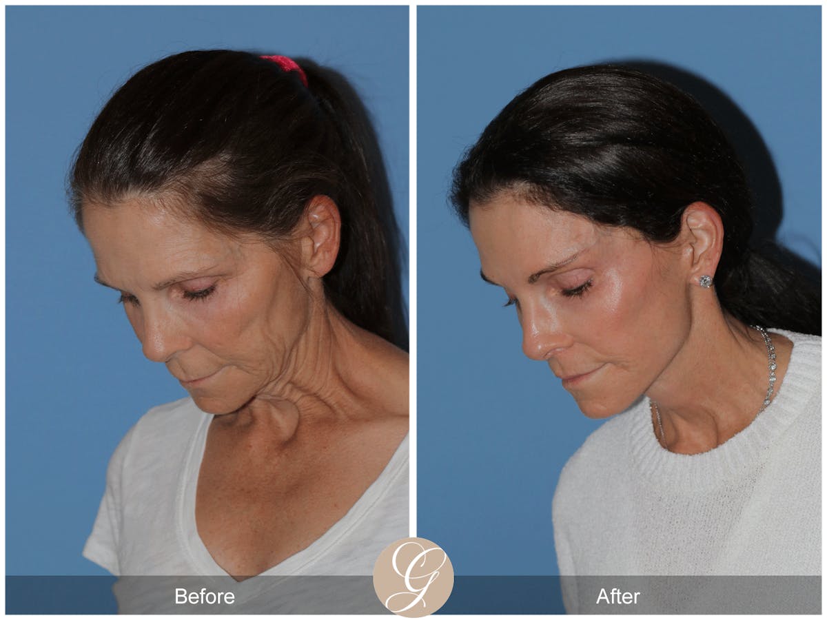 Preservation Facelift Before & After Gallery - Patient 421936 - Image 4