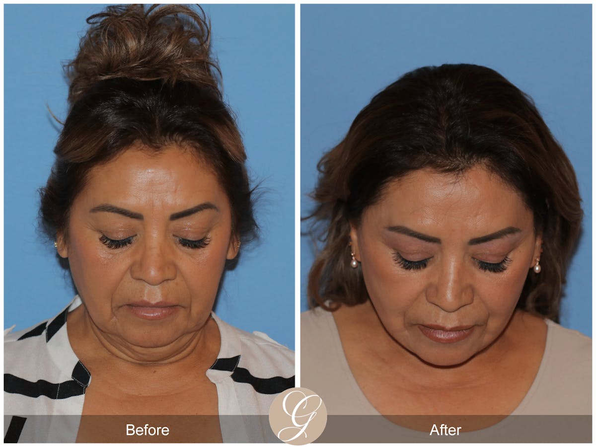 Preservation Facelift Before & After Gallery - Patient 627169 - Image 2